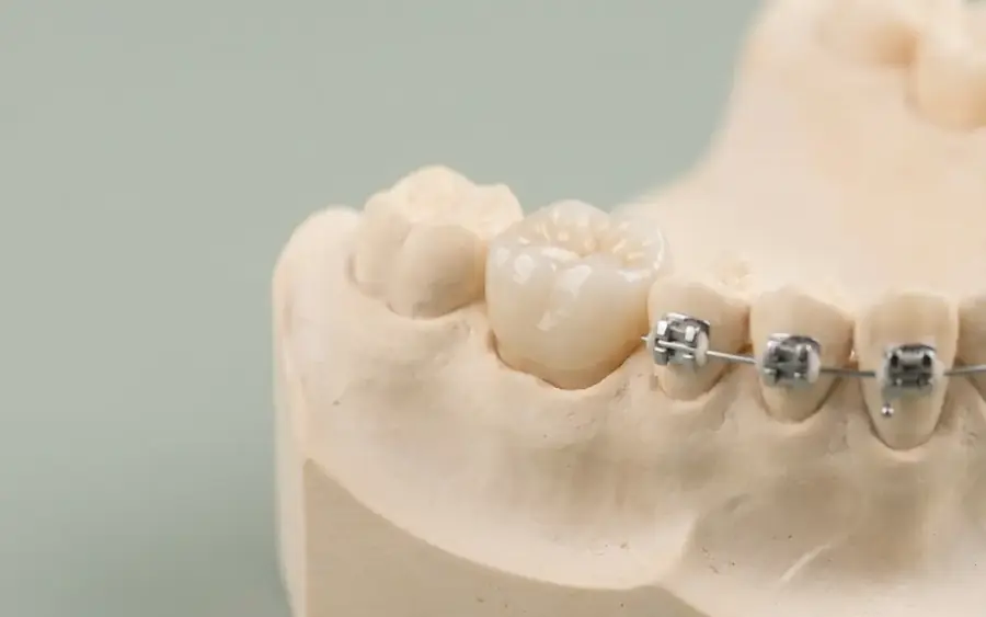 Trotz Kronen und Implantaten