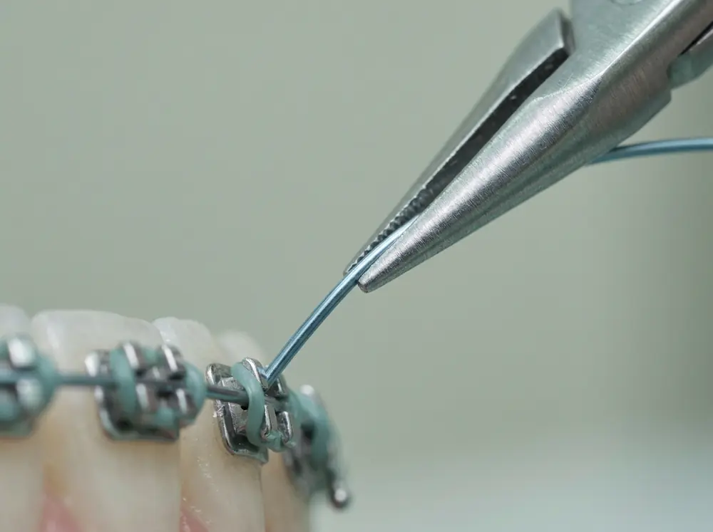 Feiner Bogen wird mit einer Zange in die Brackets eingesetzt