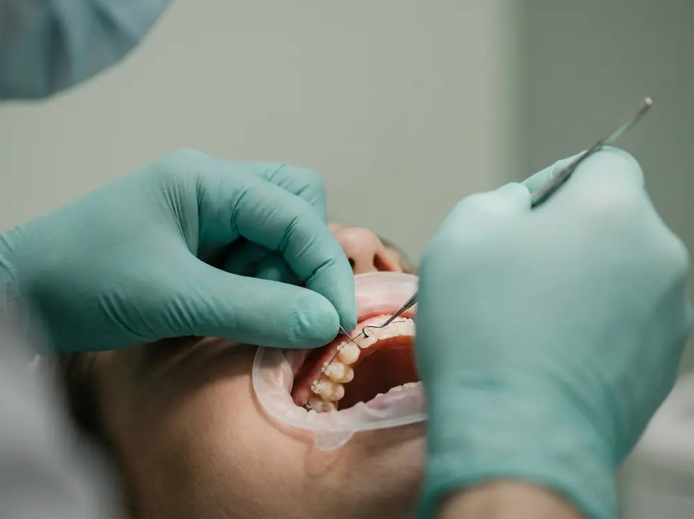 Bogen wird in den Brackets nachgestellt